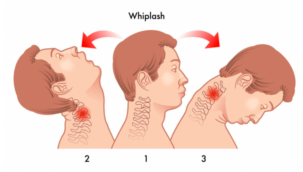 whiplash care in Lakewood WA